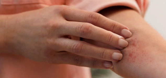 Essential Tips to Prevent Rashes in skins